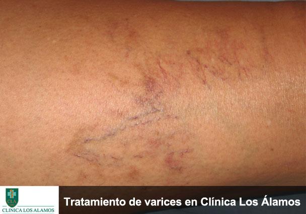 ¡Estudiamos y tratamos tus varices!