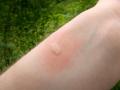 ¡Cuidado con las picaduras de insectos! y sus posibles reacciones alérgicas.